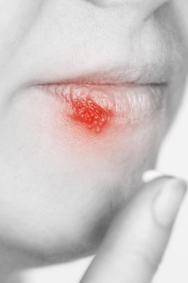 Cold Sores